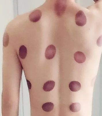 邓莎被烧伤原因,邓莎拔火罐被烧伤视频