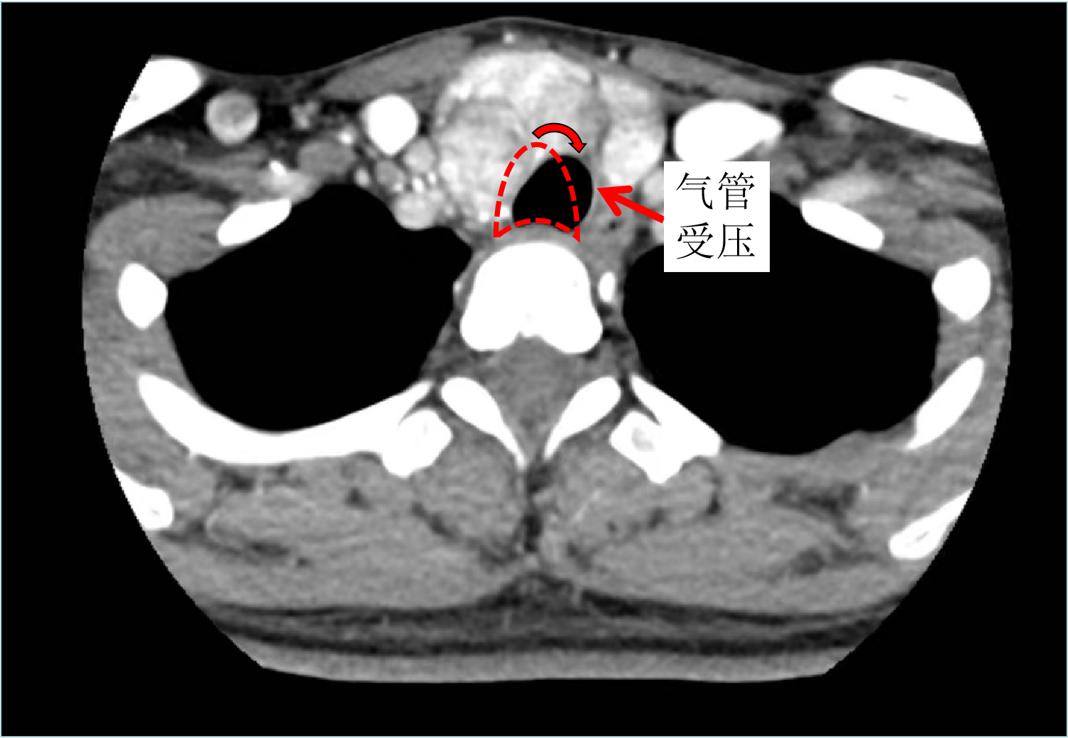 哈尔滨微创消融甲状腺结节哪家好,甲状腺结节微创消融术的过程