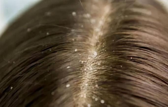 头皮长了个疙瘩破了怎么办,头皮为啥老长粉刺之类的疙瘩