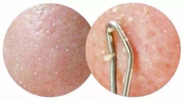 脸上长白色米粒痘痘怎么快速消除,脸上痘痘里面白色米粒是什么东西