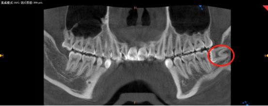 长智齿是不是因为要变聪明,长智齿是不是因为聪明一点