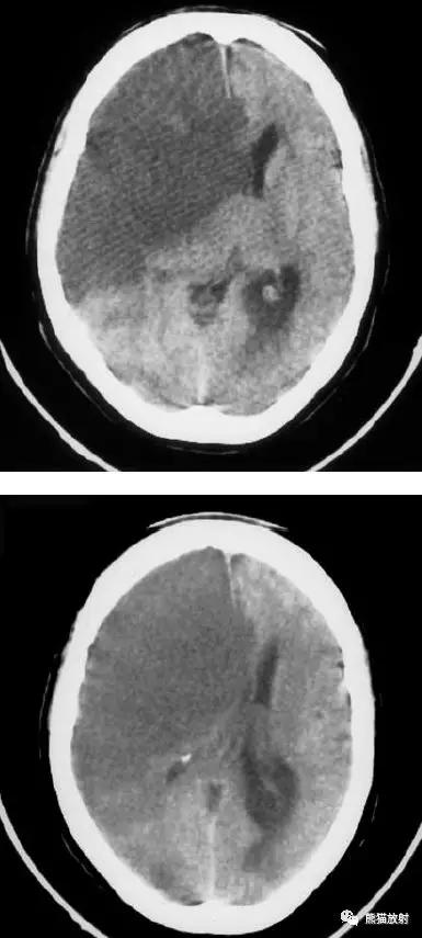 各部位脑梗死ct影像讲解,脑梗死ct影像最简单的是什么表现