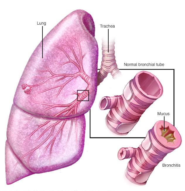 年轻人肺气肿的症状和治疗方法,肺气肿自愈的症状和治疗方法