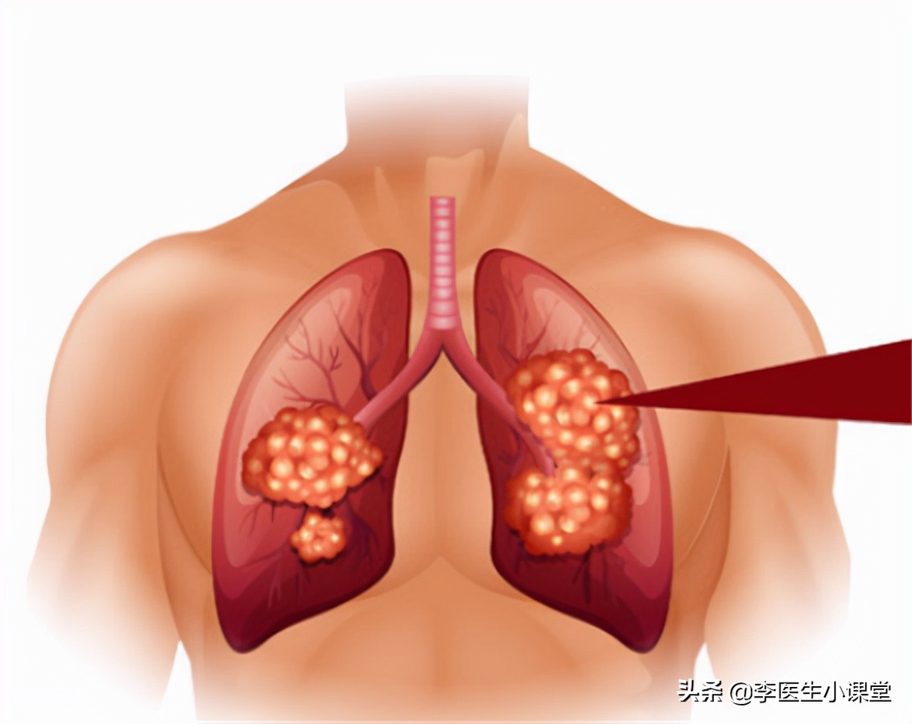 肺癌晚期双腿无法走路,肺癌晚期出现双腿栓塞怎么办