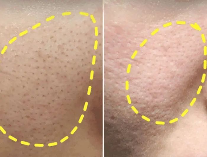 鼻头毛孔粗大如何改善缩小毛孔,皮肤毛孔粗大出汗可以缩小毛孔吗