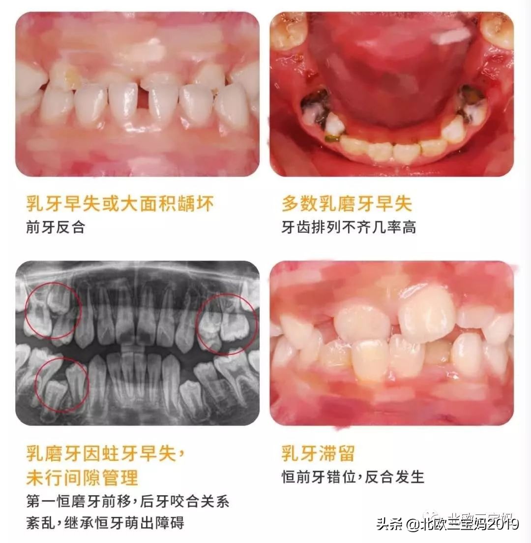 5岁小孩打全麻治蛀牙有影响吗,3岁孩子全麻风险大吗