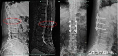 没有外伤怎么会肋骨骨折,没有外伤腰椎骨折是什么原因