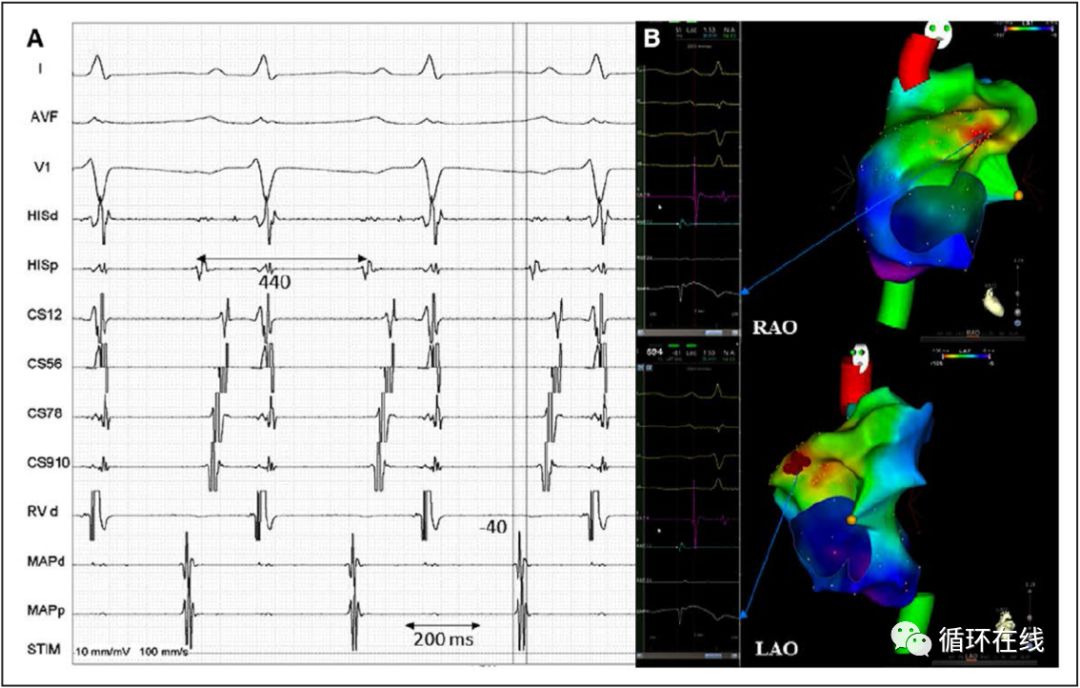 「彤心飞传」局灶房性心动过速治疗的新策略：伊伐布雷定