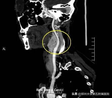 鼻咽癌导致颈部包块是早期吗,颈部包块怎么治疗最好