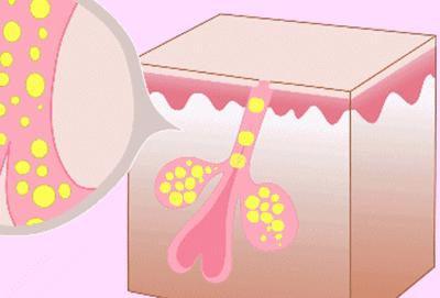 挤不出来的粉刺是什么,挤不出来的闭口自己能消失么