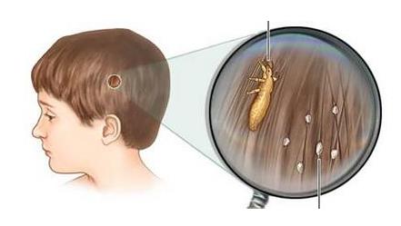 头上有虱子卵的虱子怎么彻底清除,头上长虱子怎么彻底去除更方便