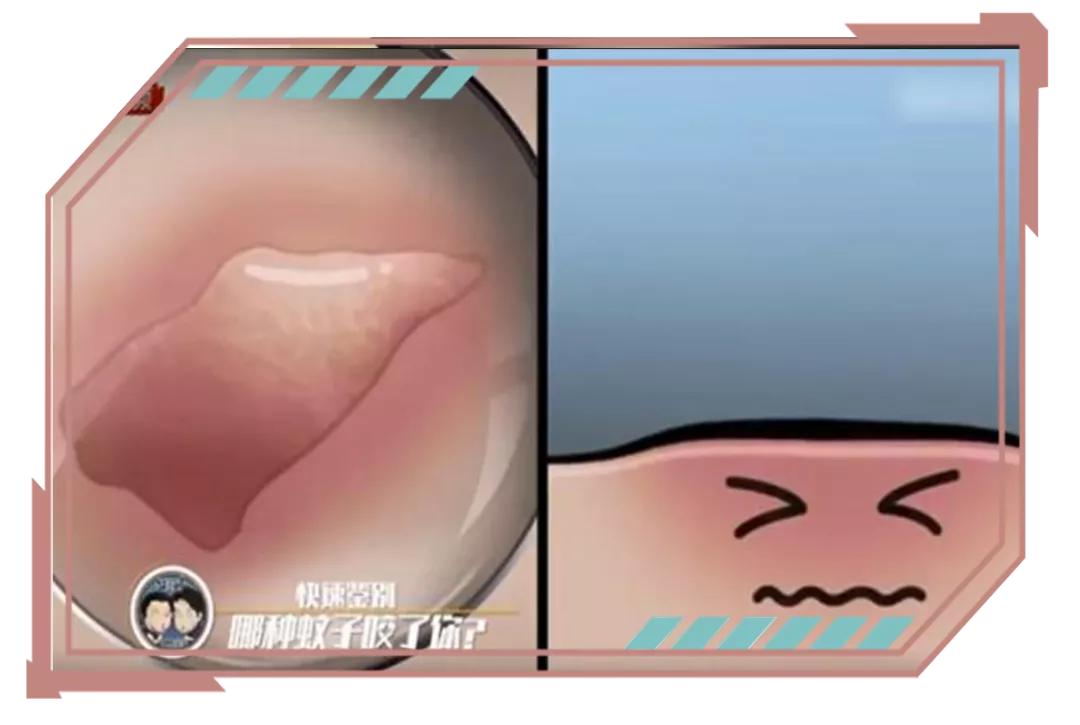 睡觉被咬了个包痒肿,手掌被咬了个包又痒又疼