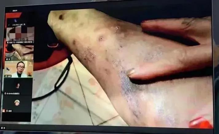 张强医生集团启动静脉血栓“空中门诊”(每日限量提供体验兑换券