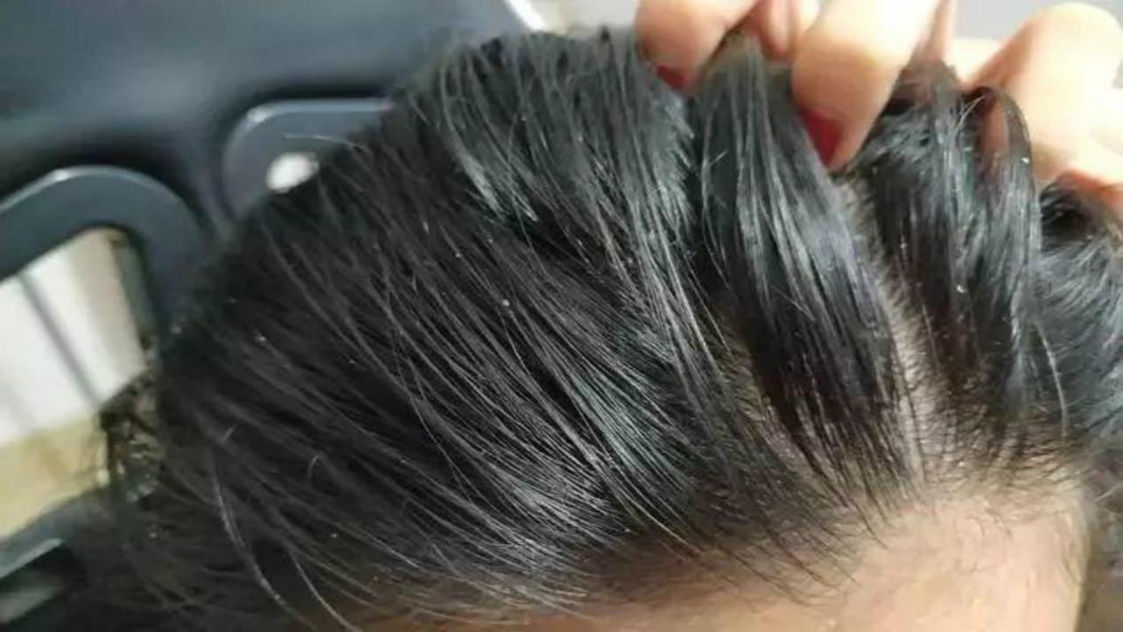 头皮屑反反复复的怎么治疗,头皮屑反反复复是什么原因造成的