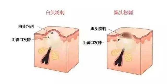 闭口粉刺痘痘黑头白头的区别,开口粉刺和闭口怎么区分