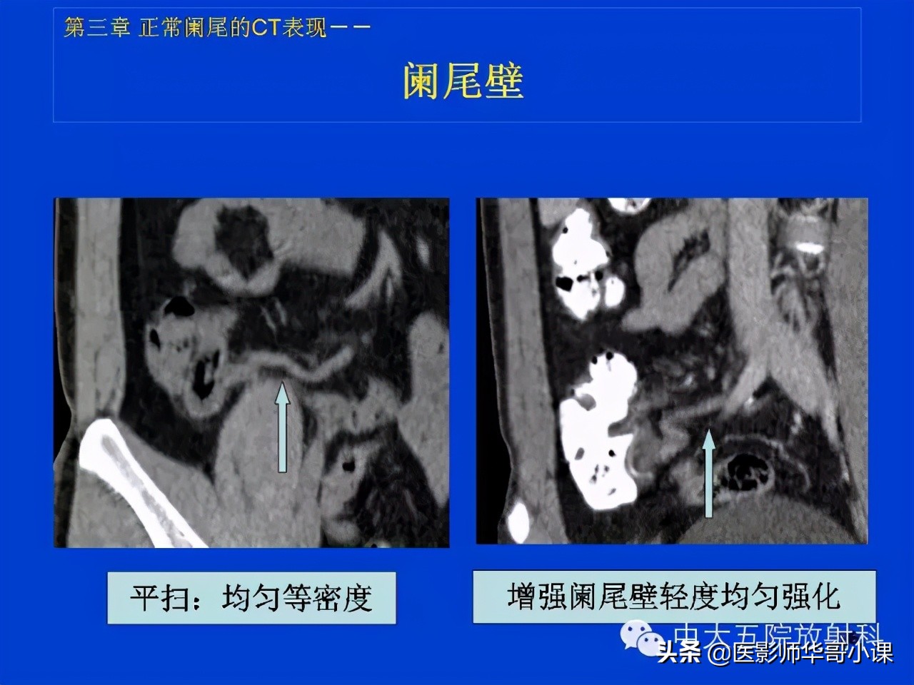 阑尾炎课件,阑尾炎的超声课件