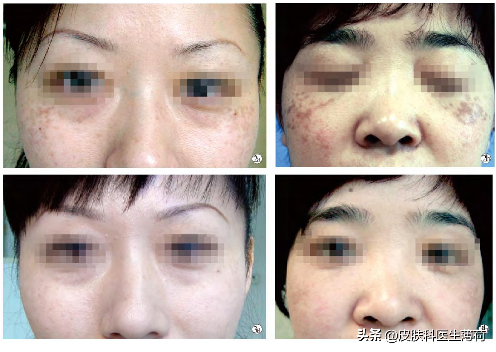 脸上激光了能喝中药吗,激光祛斑可以喝中药吗