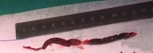 脚上暗藏化血栓开关,脚部静脉血栓的最快消除方法