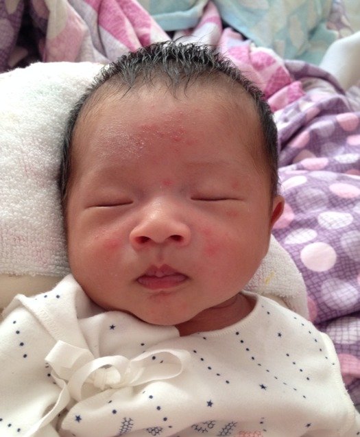 月嫂怎样解决宝宝湿疹问题,月子孩子起湿疹月嫂有责任吗