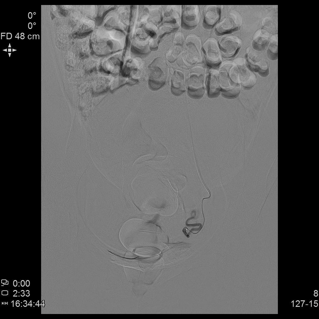 子宫肌瘤介入栓塞术排出黄水,子宫肌瘤介入消融治疗