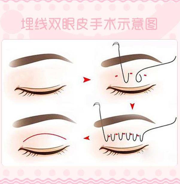 割双眼皮怎么变成内双了,割的双眼皮变成三角眼