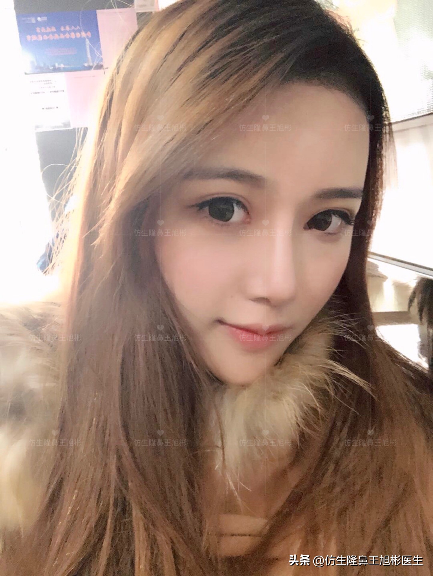 最安全的隆鼻方法,隆鼻的方法有几种及各自的优缺点