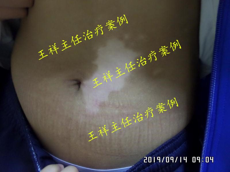 白癜风黑色素种植效果好吗,黑色素种植治疗白癜风费用