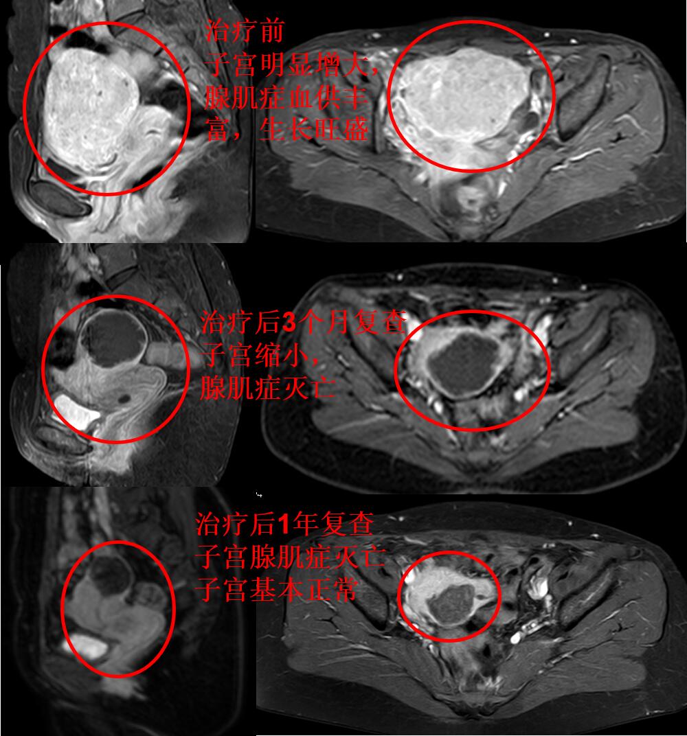 看看痛不欲生的子宫腺肌症痛经专业领域的看法与典型病例