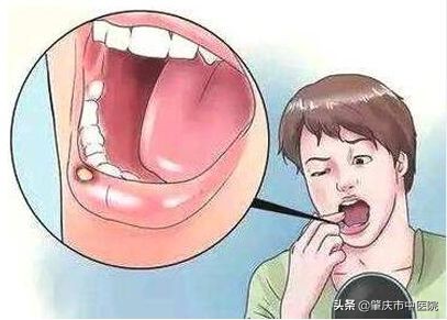 北京养生堂口腔溃疡偏方,养生堂治疗口腔溃疡方子视频