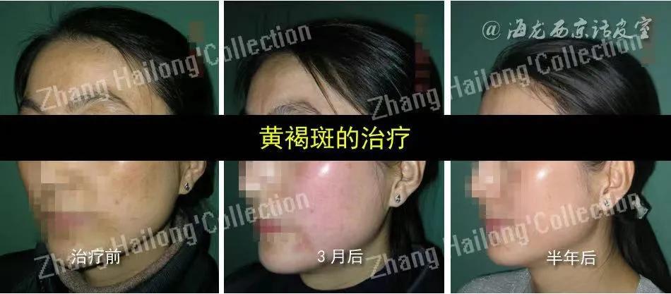 褐斑吃什么药能根除,除褐斑的办法