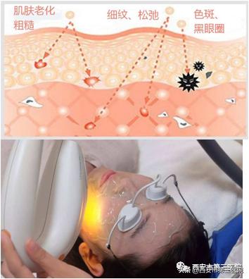 光子嫩肤的魅力,光子嫩肤带你美下去