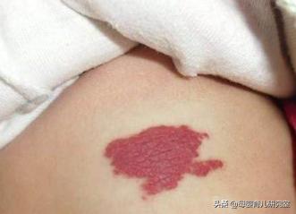 宝宝身上的青胎记能消么,宝宝身上有很多胎记淤青是为什么
