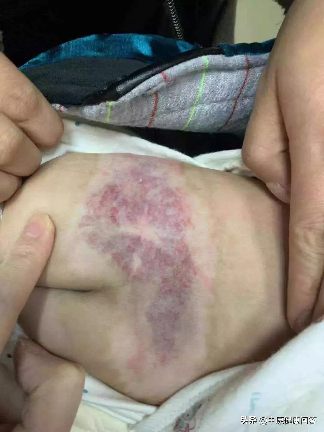 6个月女婴被侵犯后续,婴儿右侧腰部血管瘤
