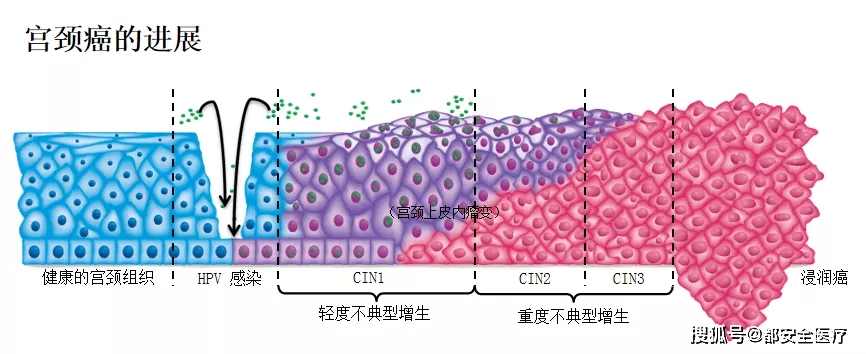 用都安全小黄盒查出hpv阳性，怎么快速转阴？