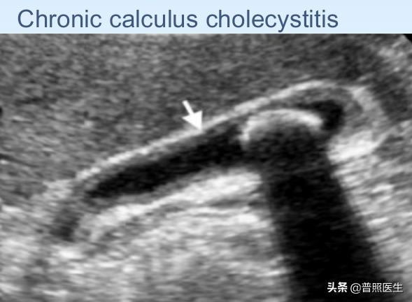 尿路小结石怎么治疗,为什么结石医生不建议做激光