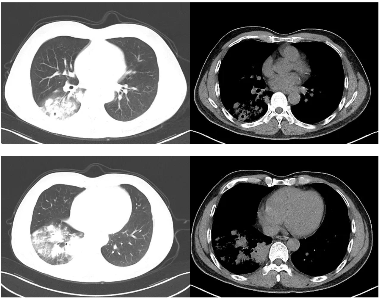 肺炎不干预治疗一般多久可以痊愈,肺炎治疗20天不见好转