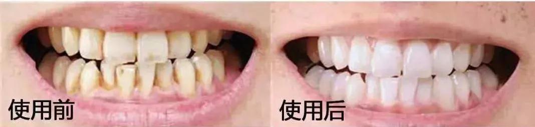 李沁牙膏真的有效果吗,李沁的黄牙变白了