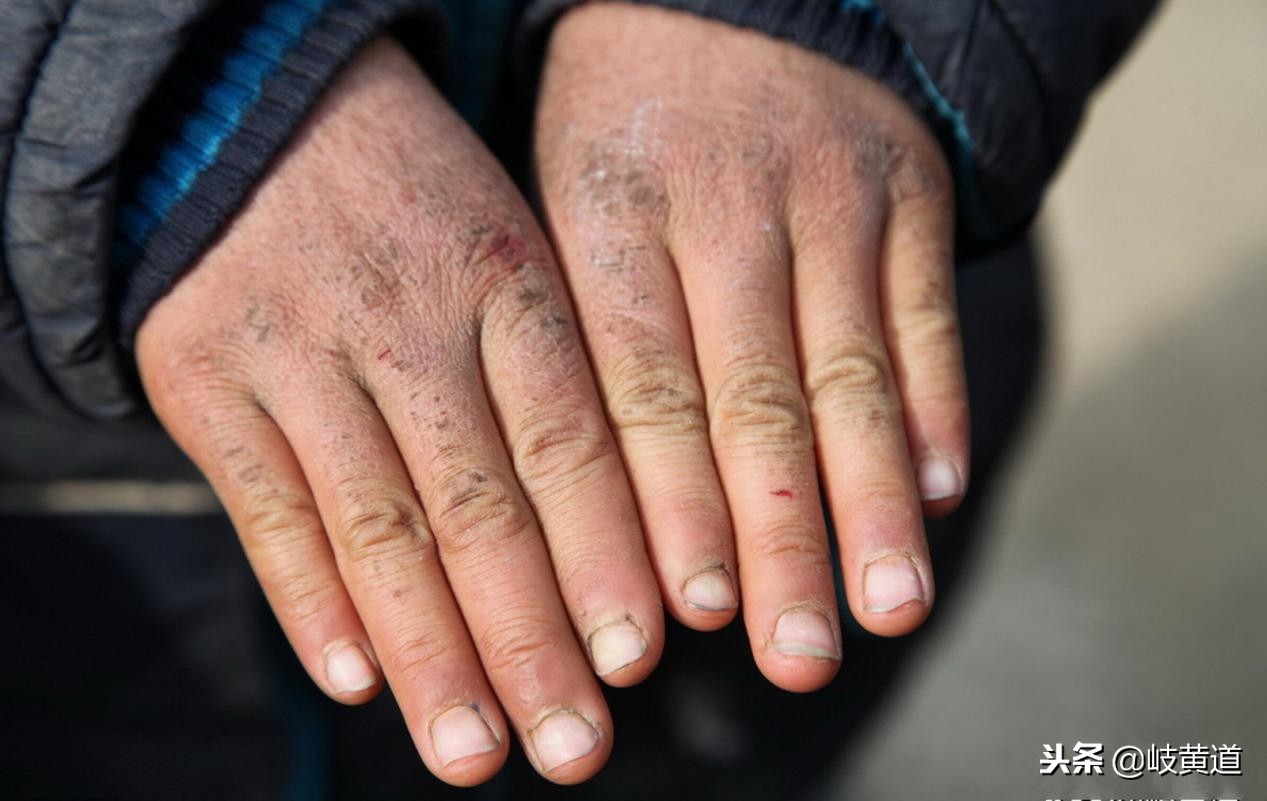 冻疮怎么预防最好办法,儿童提前预防冻疮需要涂抹什么