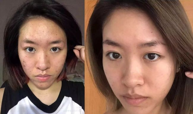 她让我知道了脸上长痘痘的原因，痘痘终于没啦