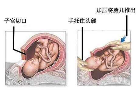 剖腹产让人感动的话,剖腹产出来感人时刻