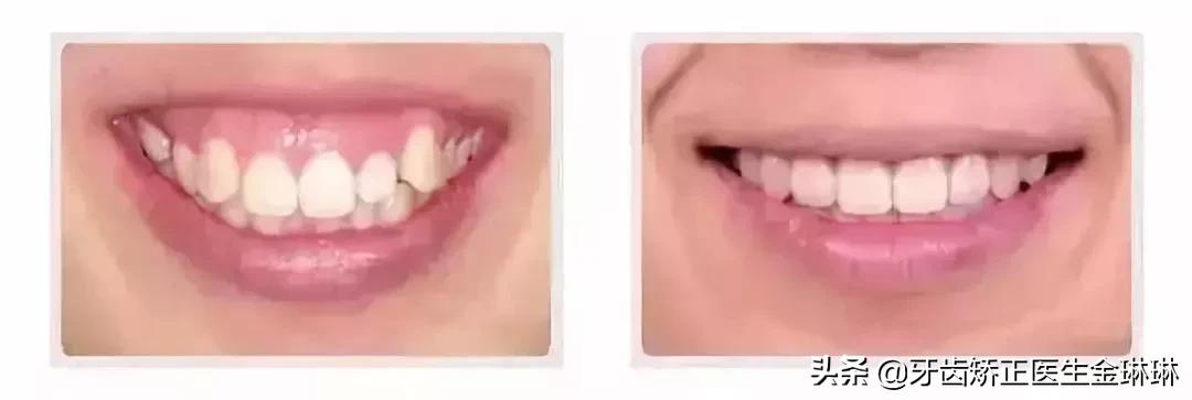 成年人露龈笑怎么矫正,如何矫正露龈笑嘴突