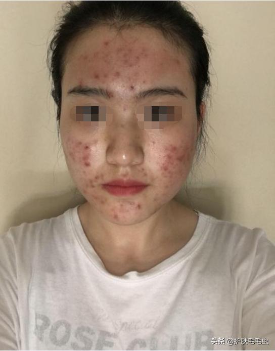 微晶祛斑骗局揭秘,微晶祛斑效果好不好