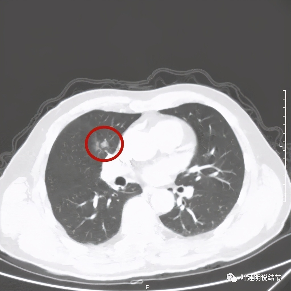 实性结节影要不要紧,实性结节穿刺活检为良性