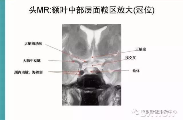 电子版头颅ct与mri断层解剖,头颅mri血管解剖与分段详解