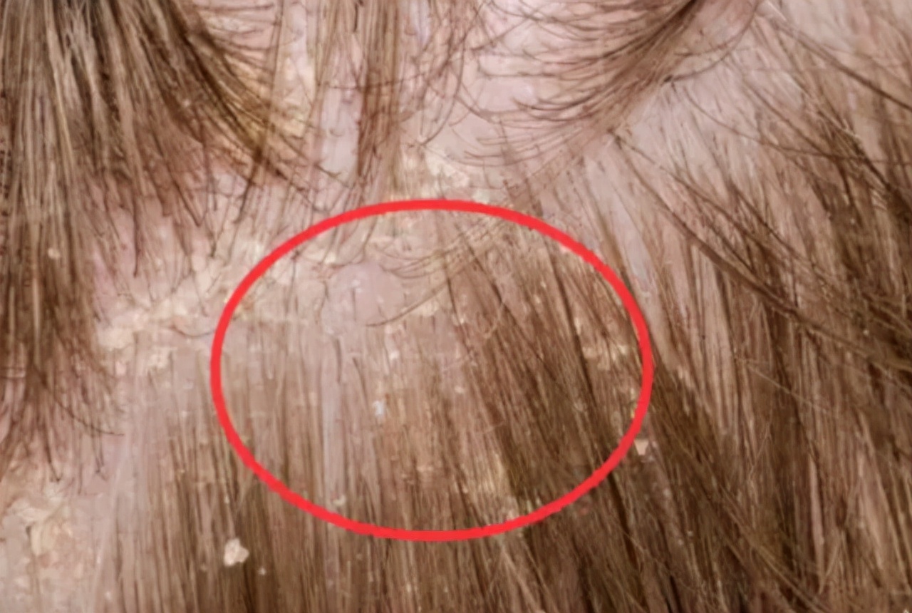 头皮上长红疙瘩脓包涂什么药膏,头皮起红色小疙瘩有脓包怎么治