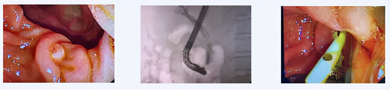 西青医院普通外科医疗团队连续运用ERCP微创技术治疗高危难病患