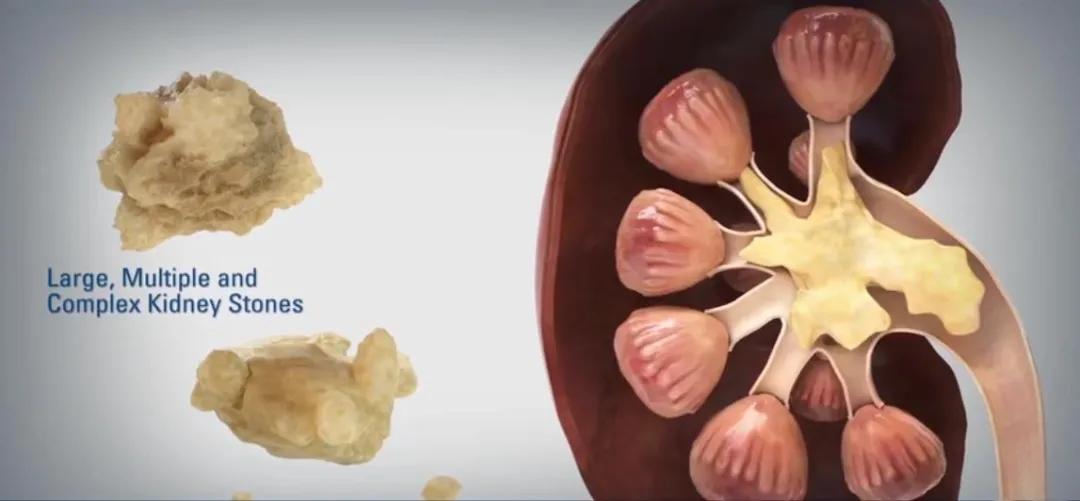 阜新治疗输尿管结石,肾盂大结石怎么处理最安全