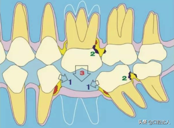 种不了种植牙还有其它办法吗,一直犹豫种牙还是镶牙