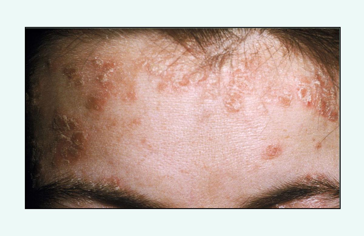 脸上的红疙瘩疼是什么原因,脸上的各种疙瘩