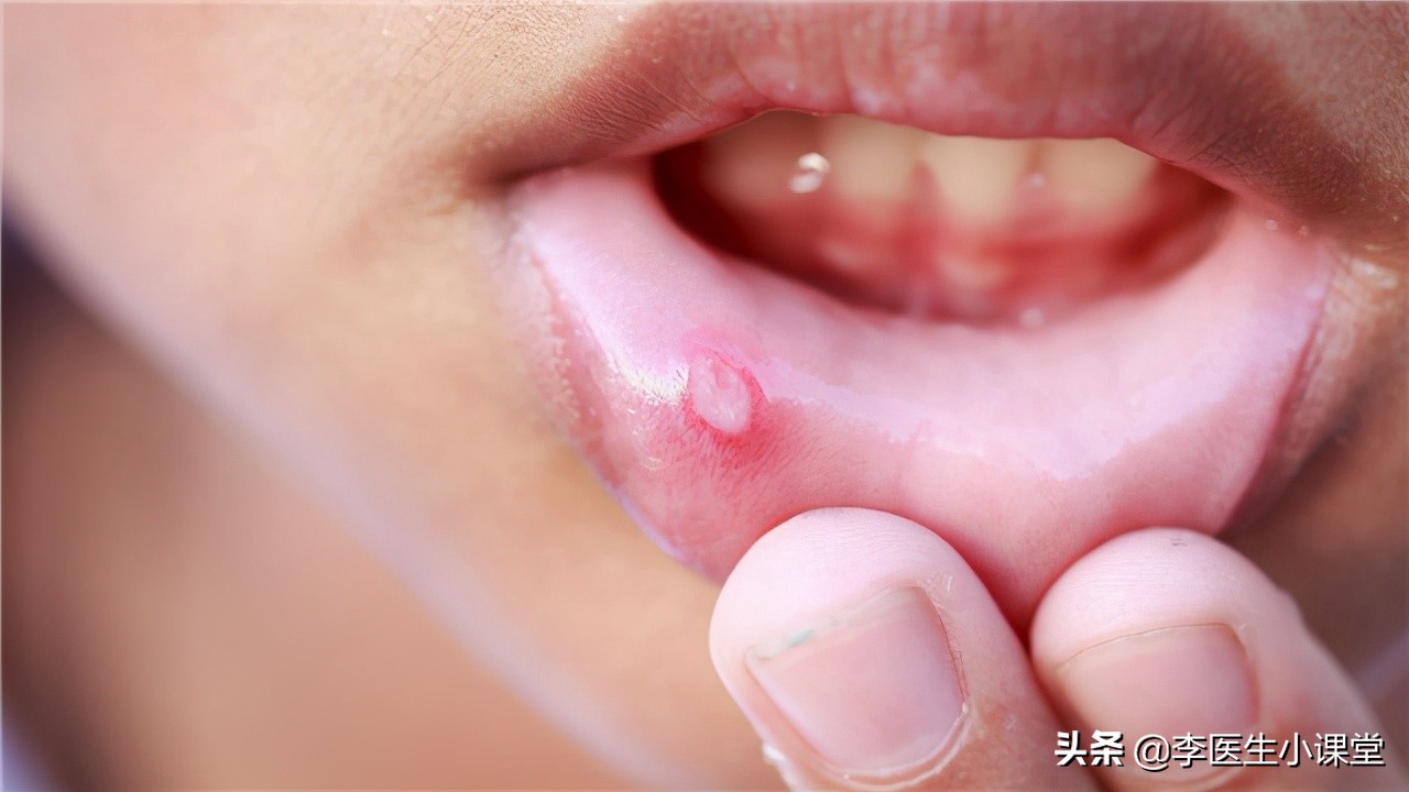 口腔溃疡可以同时吃维b2和维c吗,有一种痛叫口腔溃疡